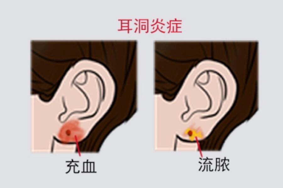 打耳洞后的注意事项 打耳洞后的注意事项主要有以下几点: 	 1,避免