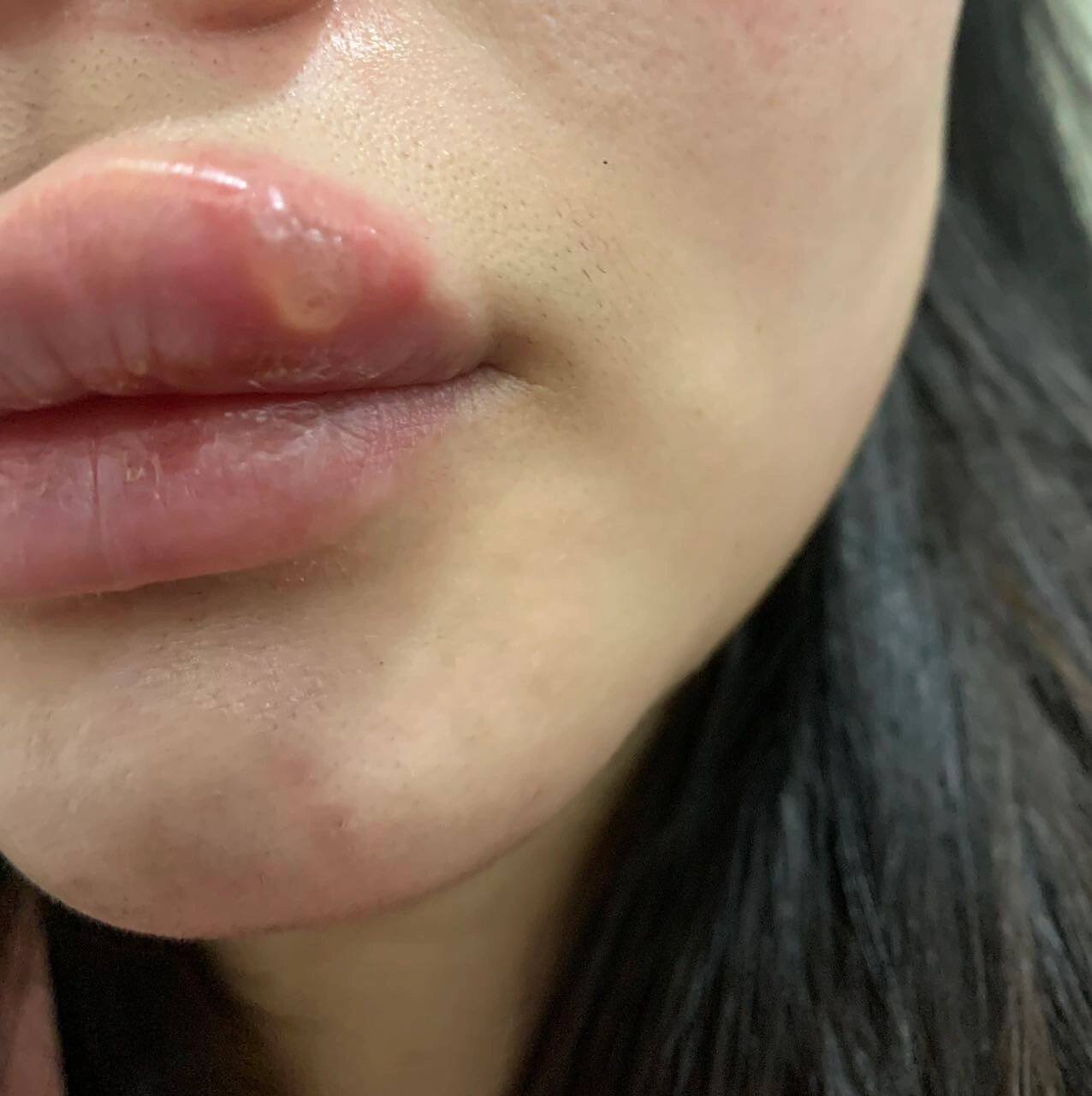 嘴唇水泡 某天早上睡醒忽然这样了 反反复复的,距离上次嘴巴起泡已经