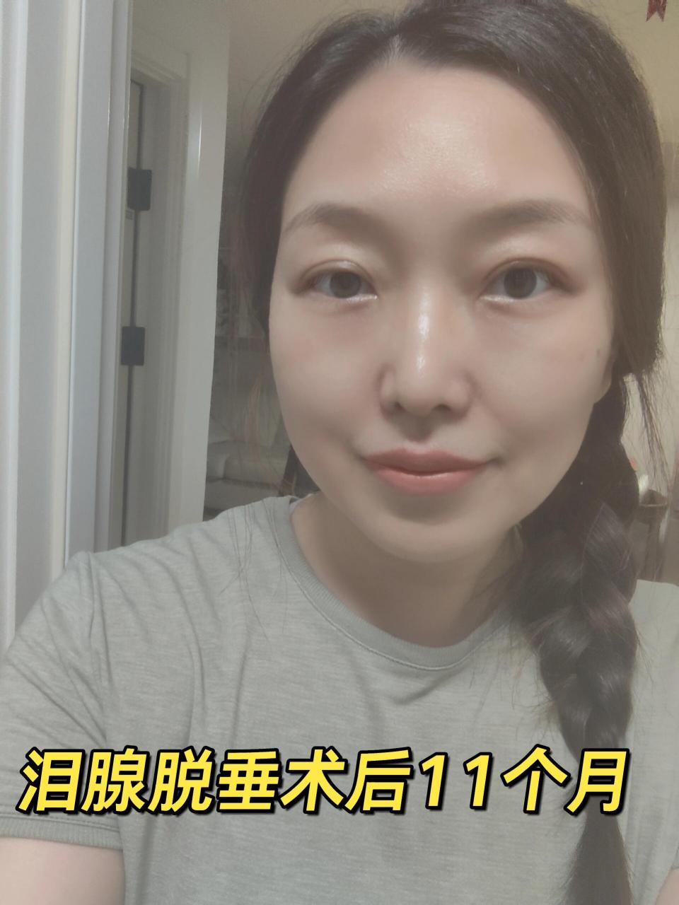 泪腺脱垂跟过度流泪有关系吗?
