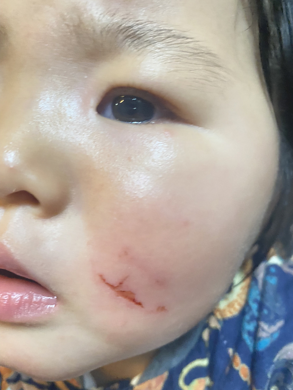 宝宝摔伤脸蛋 会不会留疤啊 不小心摔伤 正好摔到脸蛋 姐妹们有知道涂