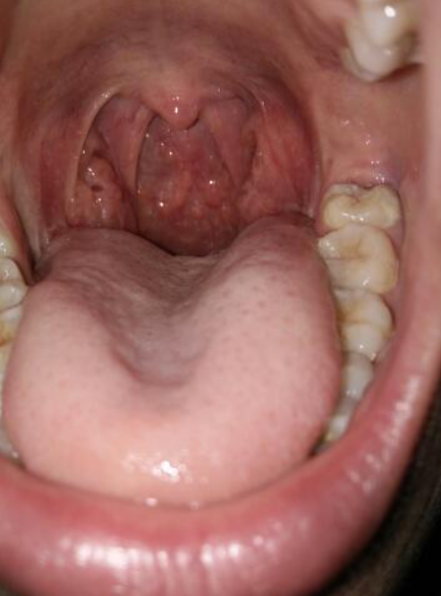 喉咙出现小红点,常见原因包括慢性肥厚性咽炎,咽后脓肿或咽部溃疡