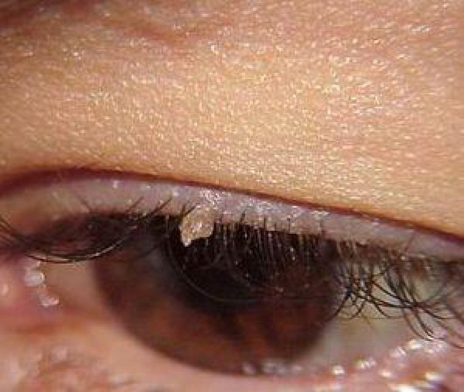 眼周这种小疙瘩要警惕,有可能是hpv阳性感 眼睛也是会感染hpv病毒的