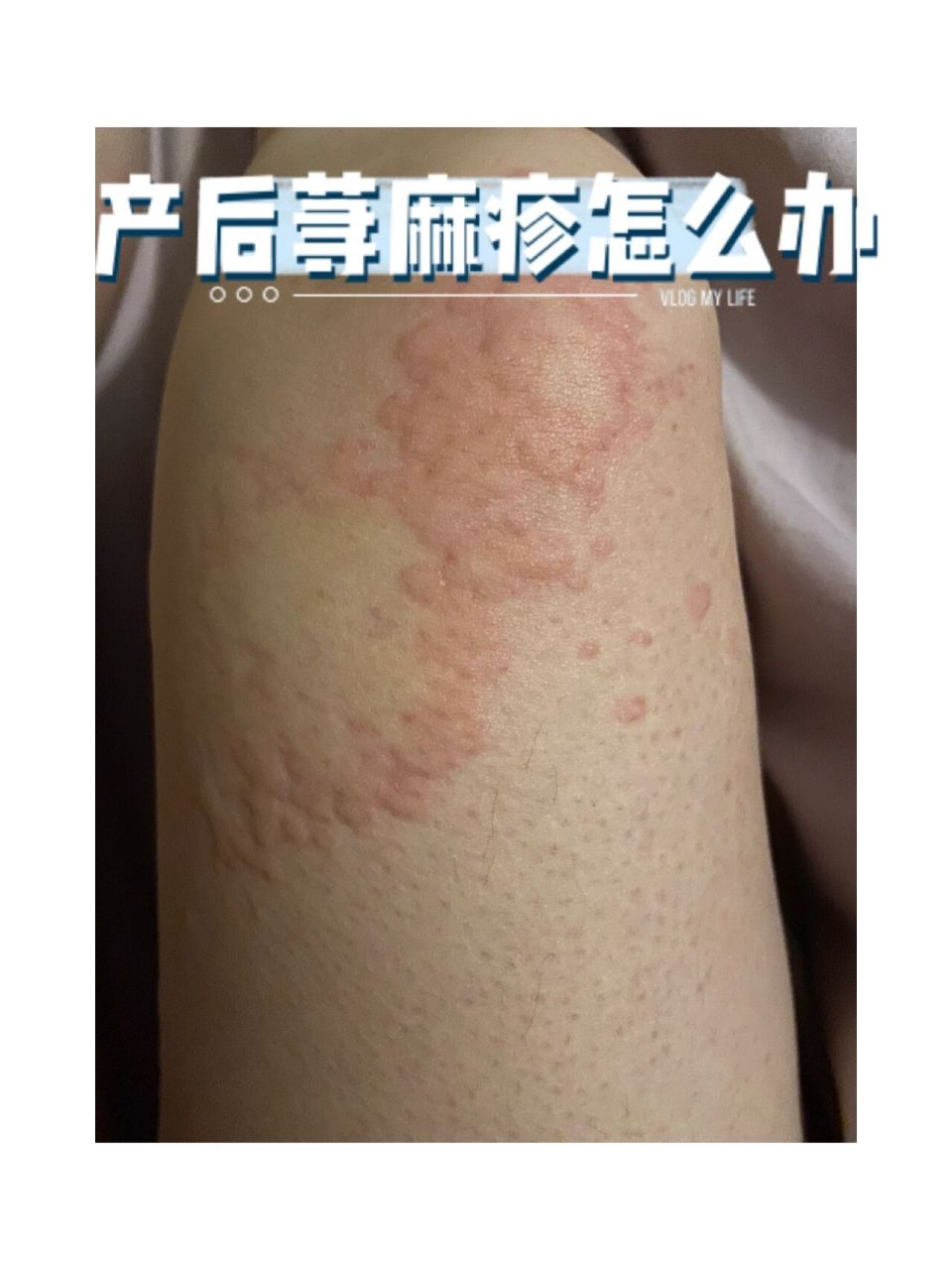 产后荨麻疹怎么办!(哺乳妈妈也可以吃的药) 慢性荨麻疹解决方案来咯!