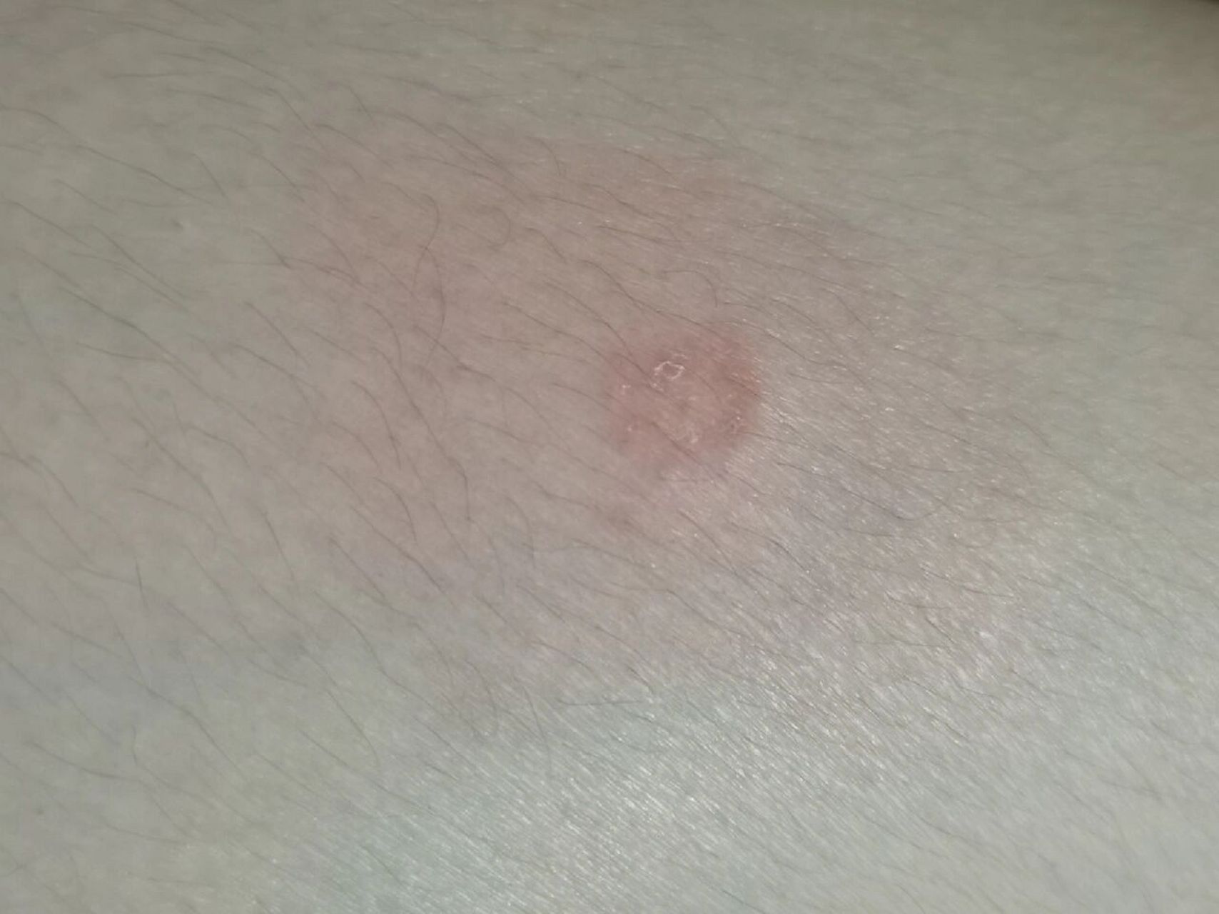 第一次遇到猫藓传染给人的,还好算小事一桩  家里养了2只猫,橘猫一