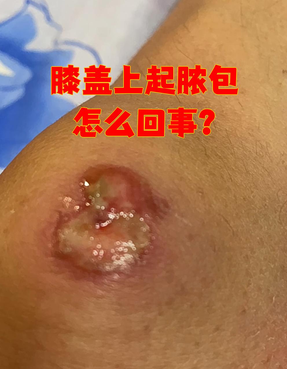 膝盖上长脓包可能由外伤引起,也可能是疖或毛囊炎等皮肤问题