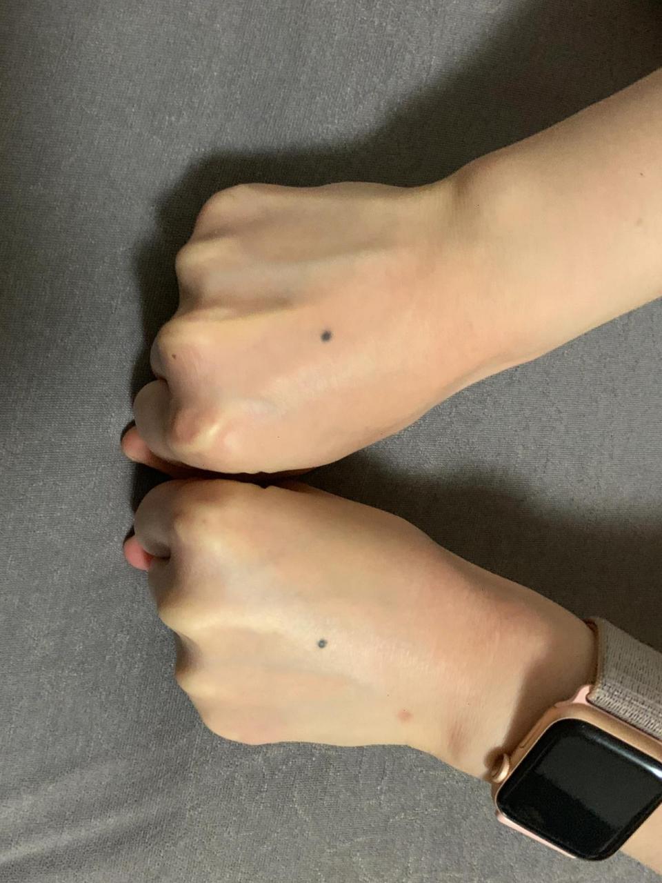 关于手背长痣/ 愿一生幸运 自我记事起,左右两只手背就有两颗对称的