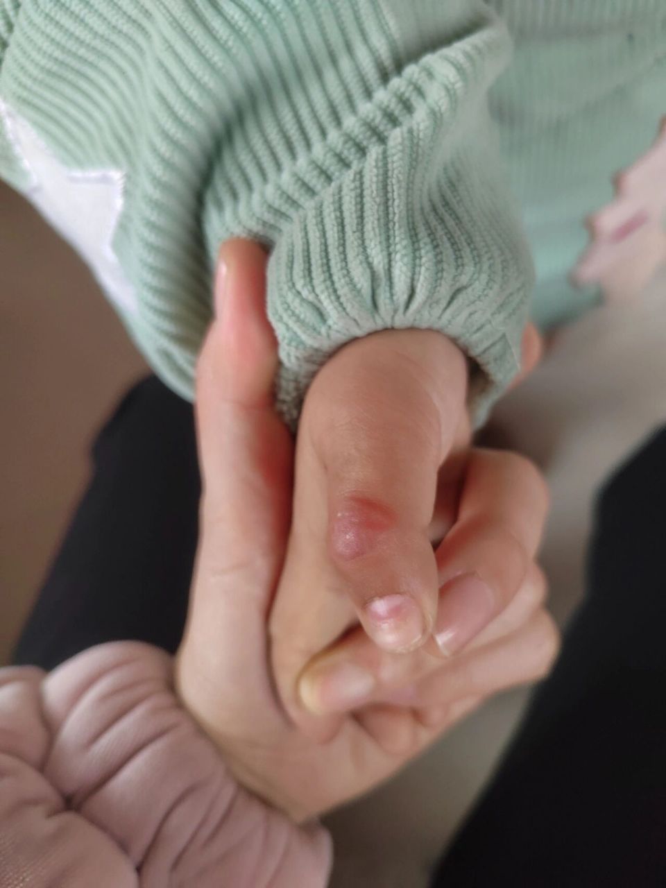 小朋友手指肿了还有小泡泡 不知道怎么回事    第一天 , 小朋友一大早