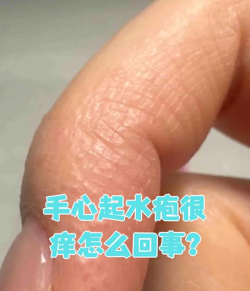 天气一热手上就起小水泡今日情况