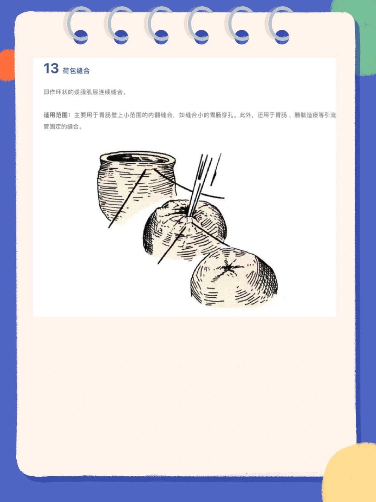 13种外科缝合方法 1 单纯间断缝合(结节缝合) 适用范围:结节缝合