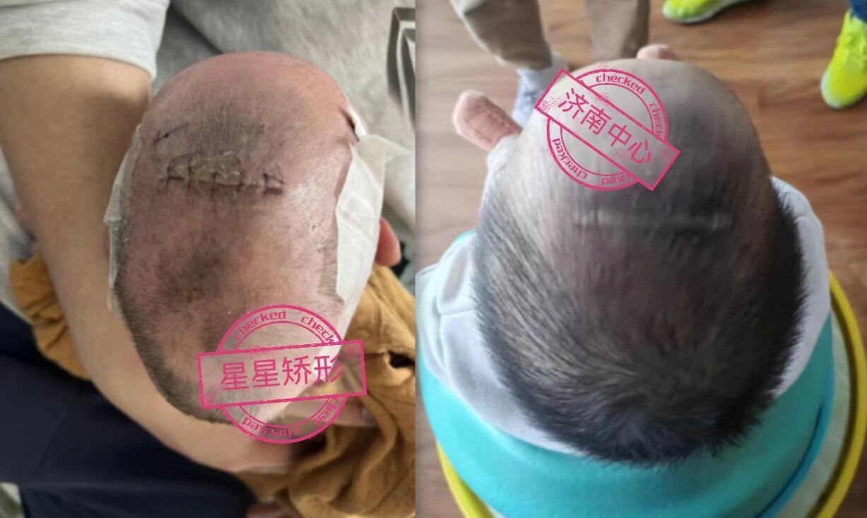 孩子头型不好要警惕颅缝早闭 孩子头型不好不要觉得