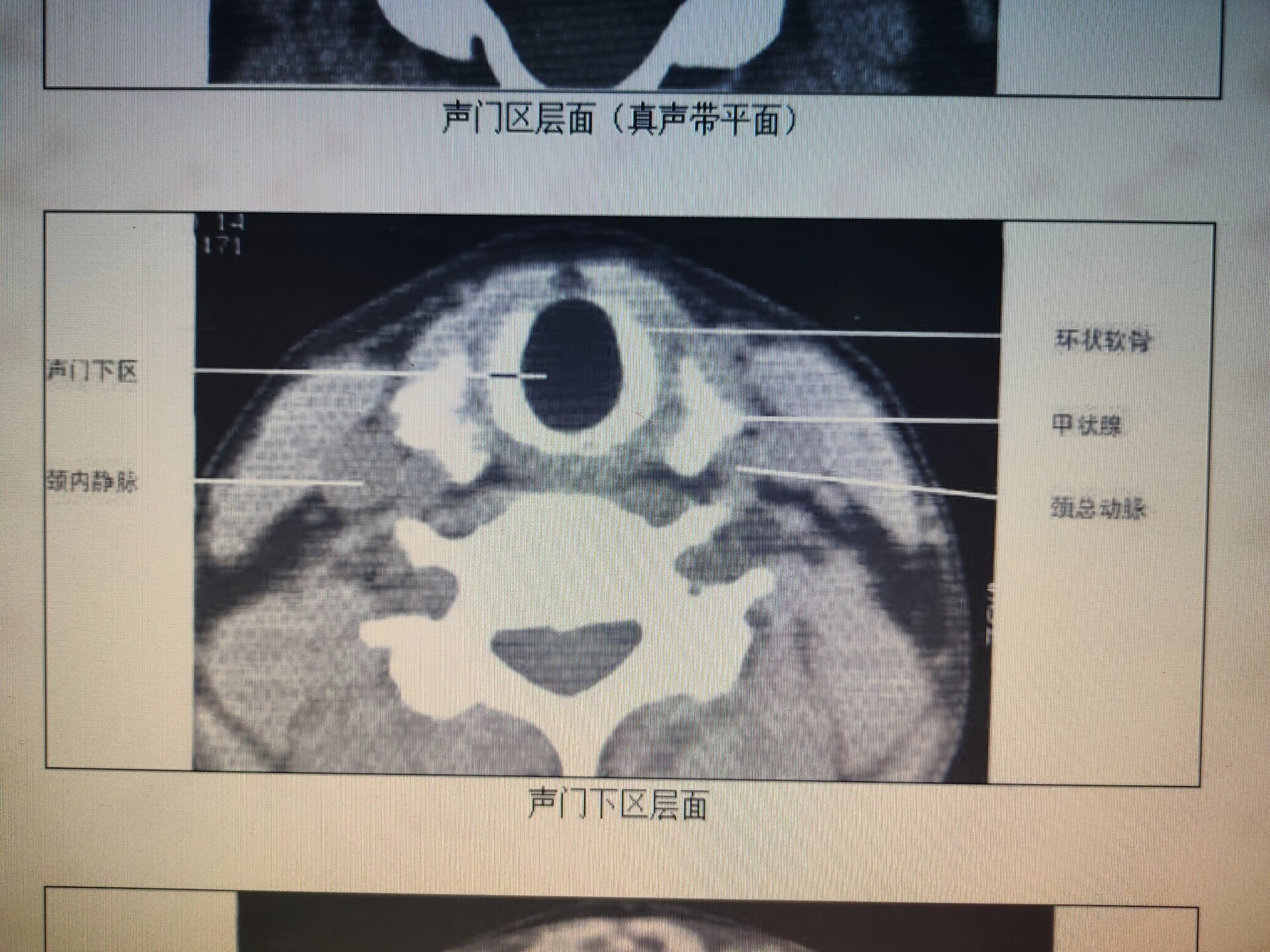 声门CT图片