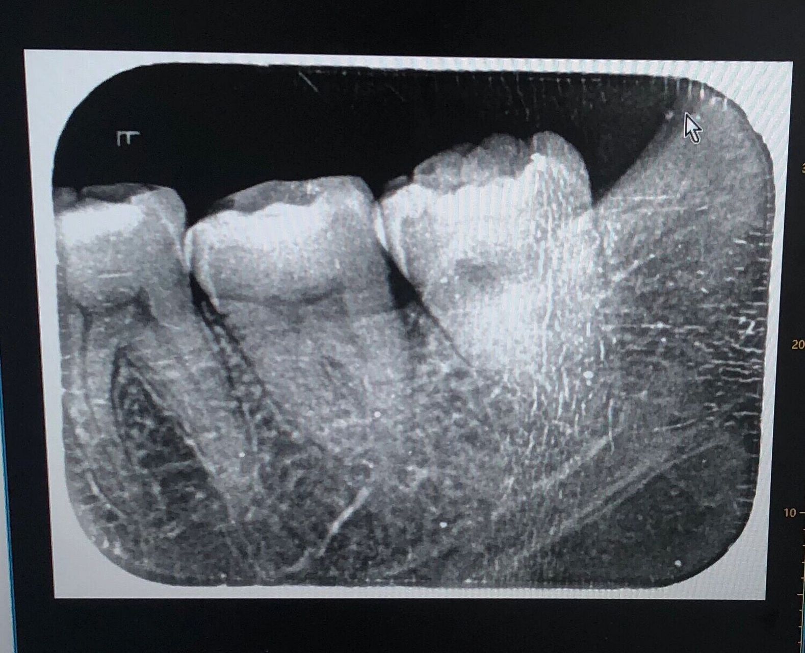 营口-马国彬口腔 四颗智齿长了仨,其中一个经常疼
