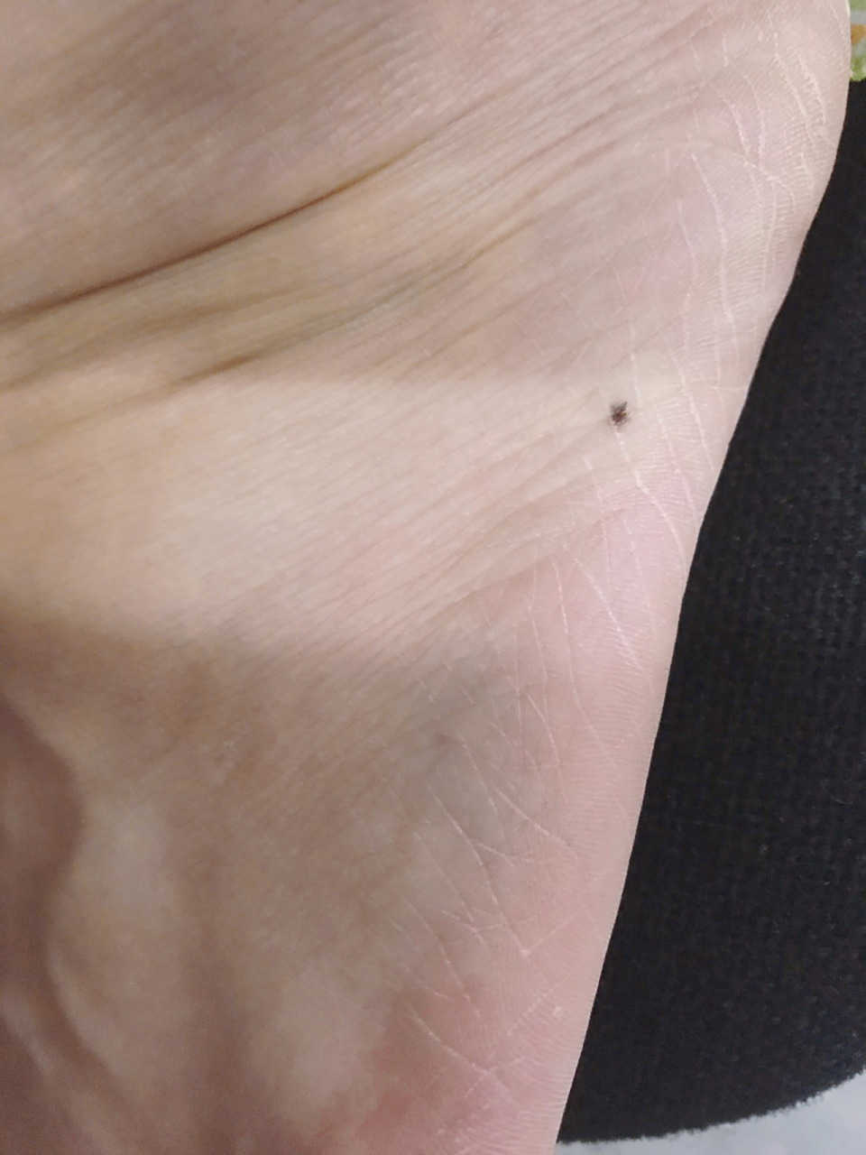 脚背黑痣切除 脚背这个黑痣长了有超过十年,之前没注意,最近发现长大