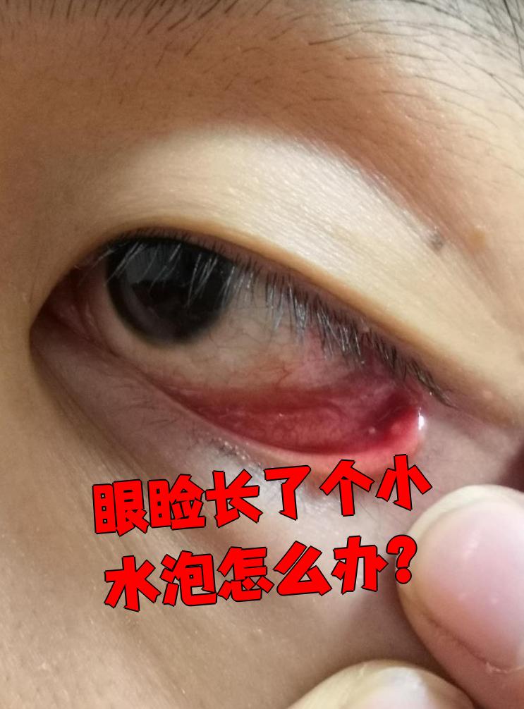 眼睑上长小水泡可能是麦粒肿,霰粒肿或睑板腺癌引起的,不同情况歇要