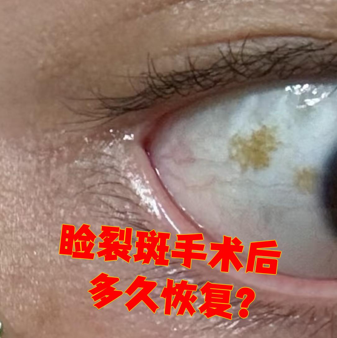 睑裂斑手术后恢复时间一般在3