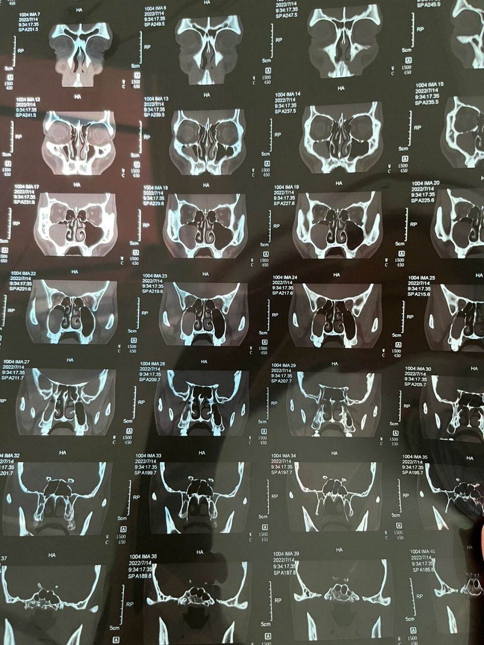 鼻窦囊肿 鼻中隔偏曲 鼻甲肥大 过敏性鼻炎 基本情况 早上起来打喷嚏