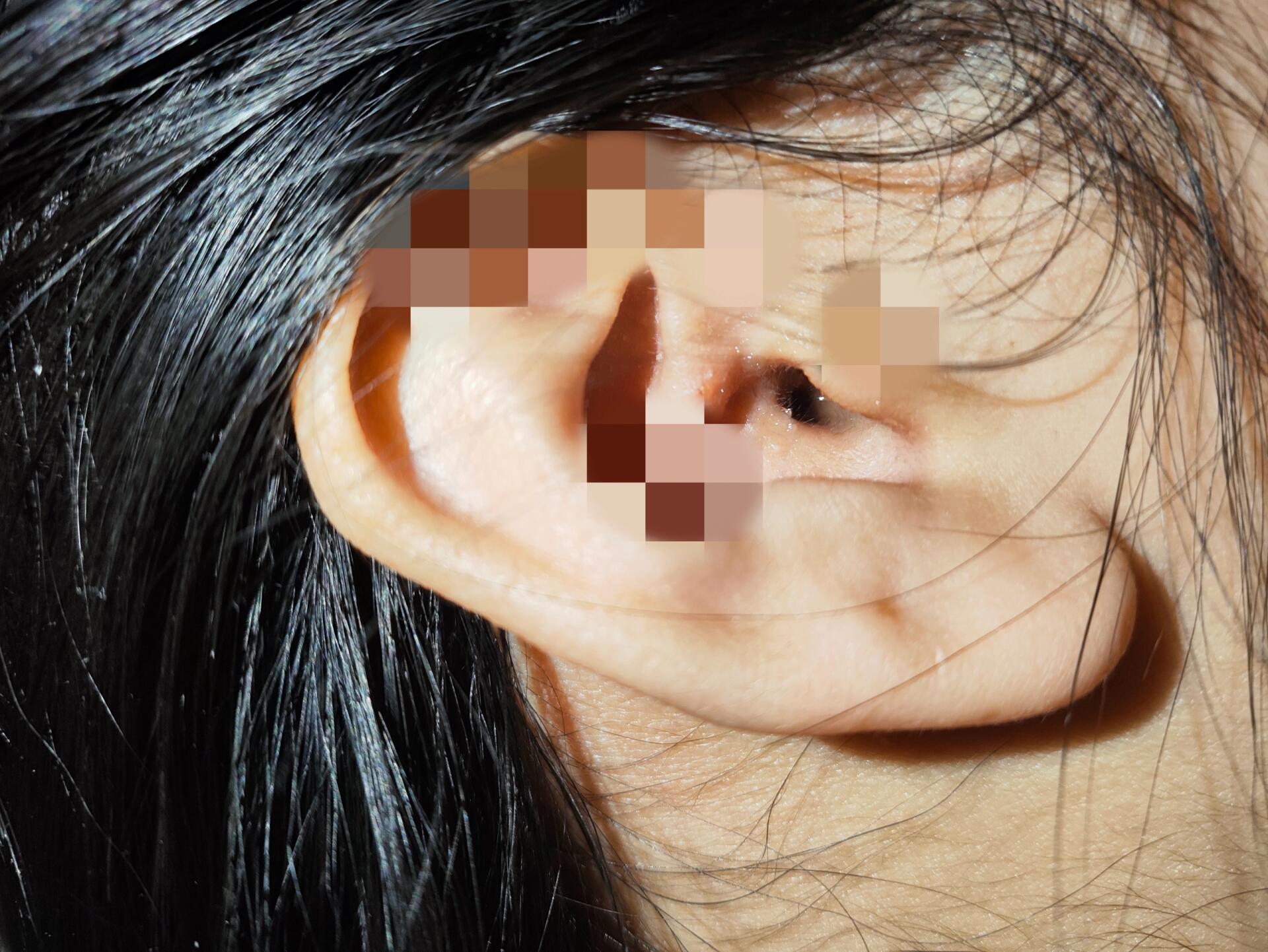 耵聍栓塞,哒咩啊哒咩!