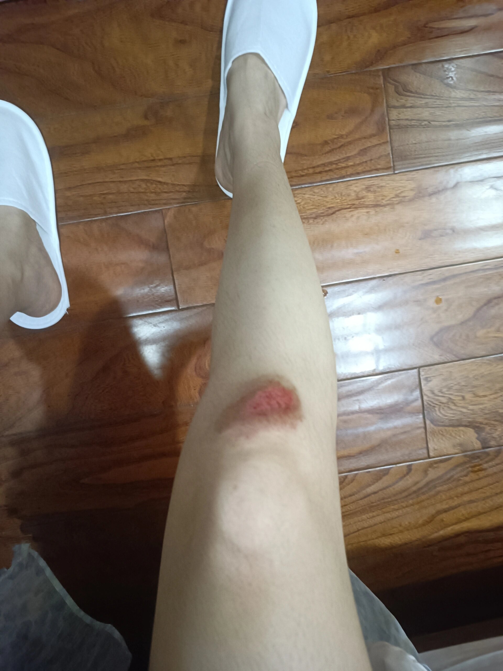 去海边玩之前 腿磕破了
