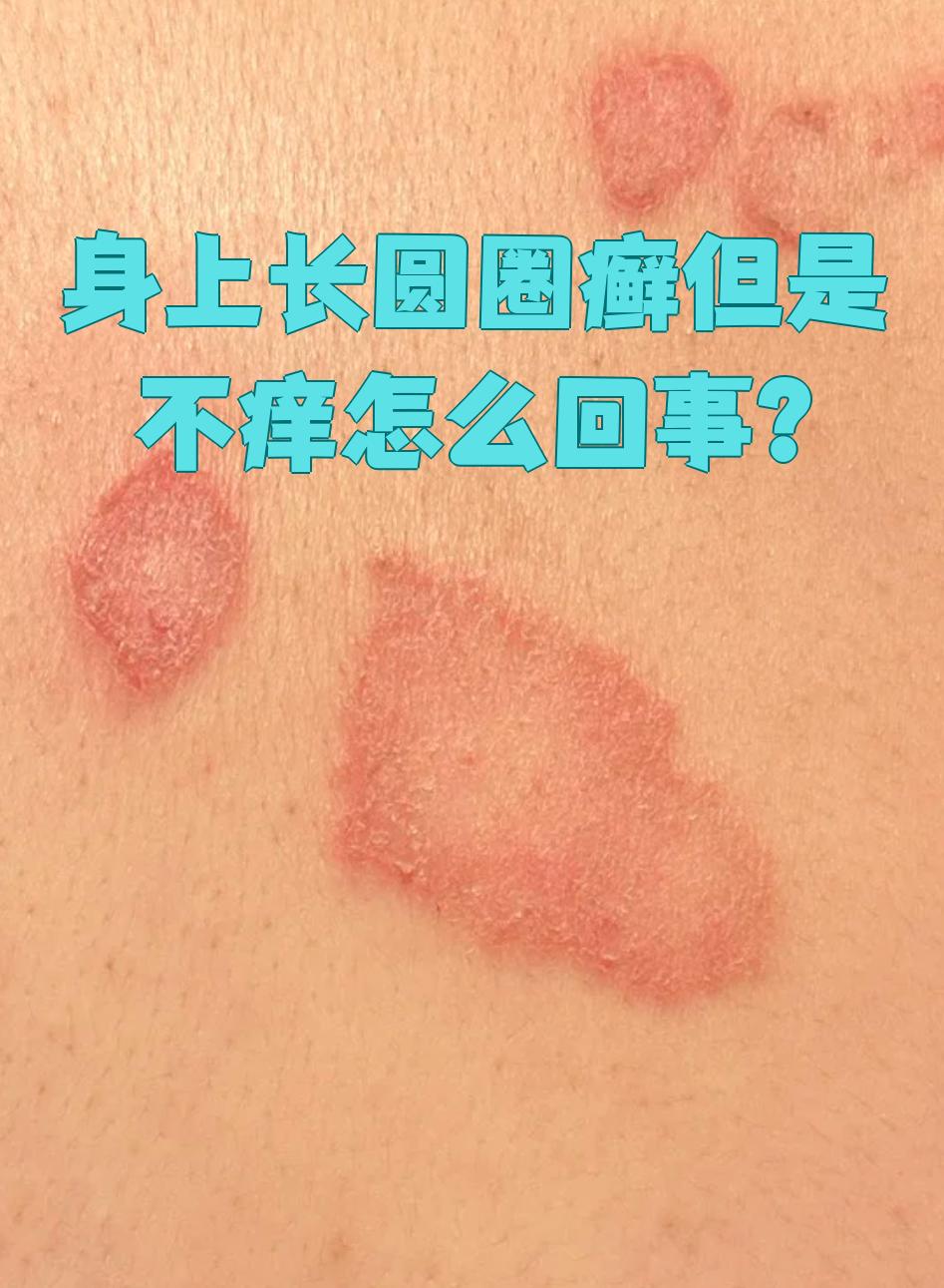 皮肤会出现红色丘疹,可能呈点滴状,斑块