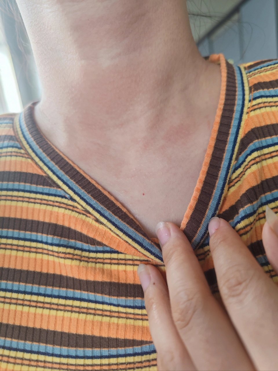 会好很多不会痒了,这个大概率是湿疹,或者过敏 脖子经常无缘故就红一