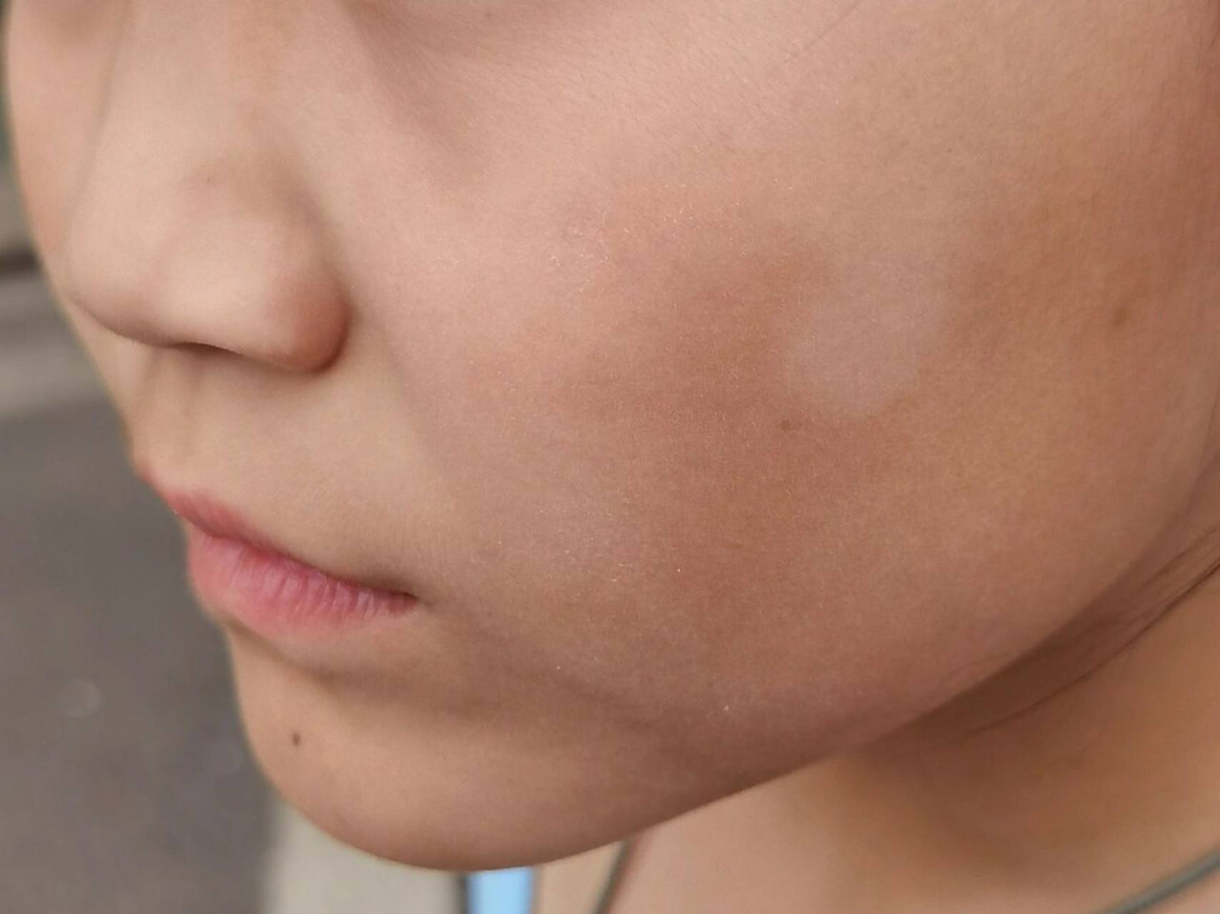 白色糠疹 小朋友肤色较黑,但一到春夏,脸上有出现一小块白斑,不痛不痒