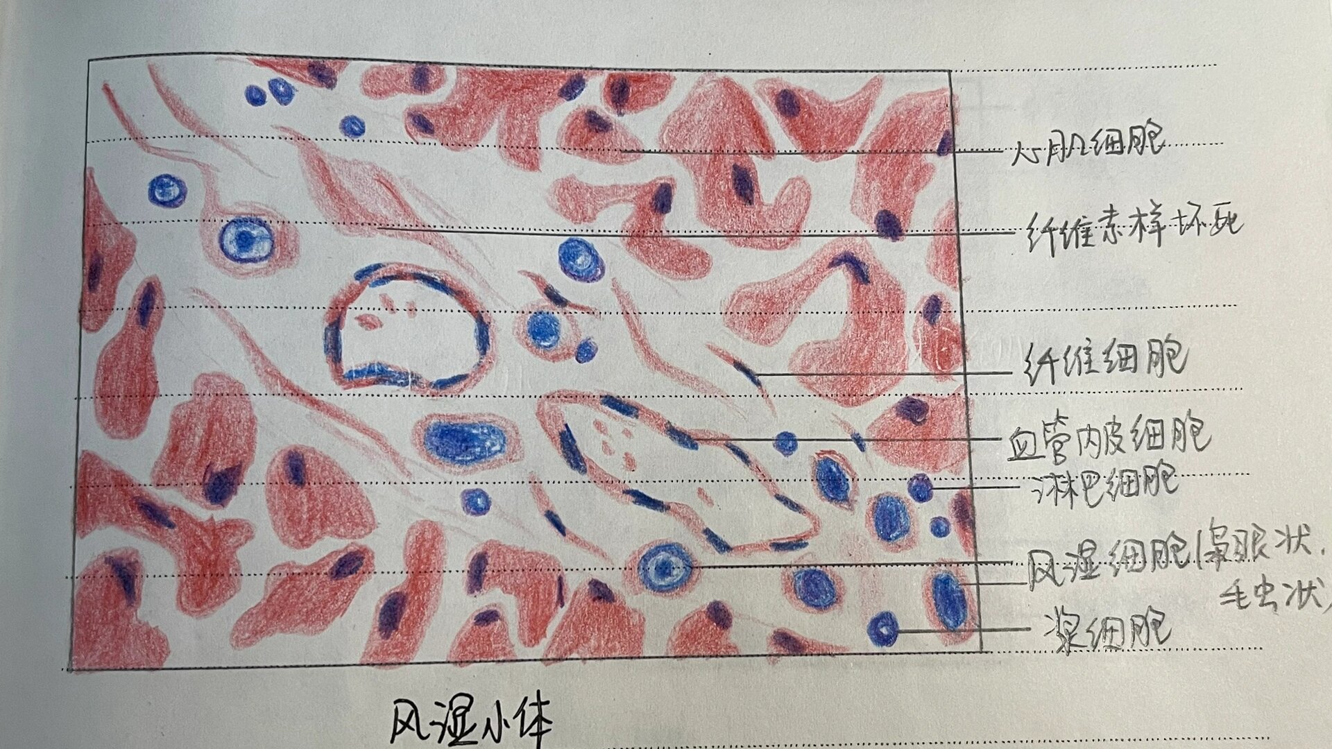 病理切片红蓝铅笔7315图 16615风湿小体 26615炎细胞 3