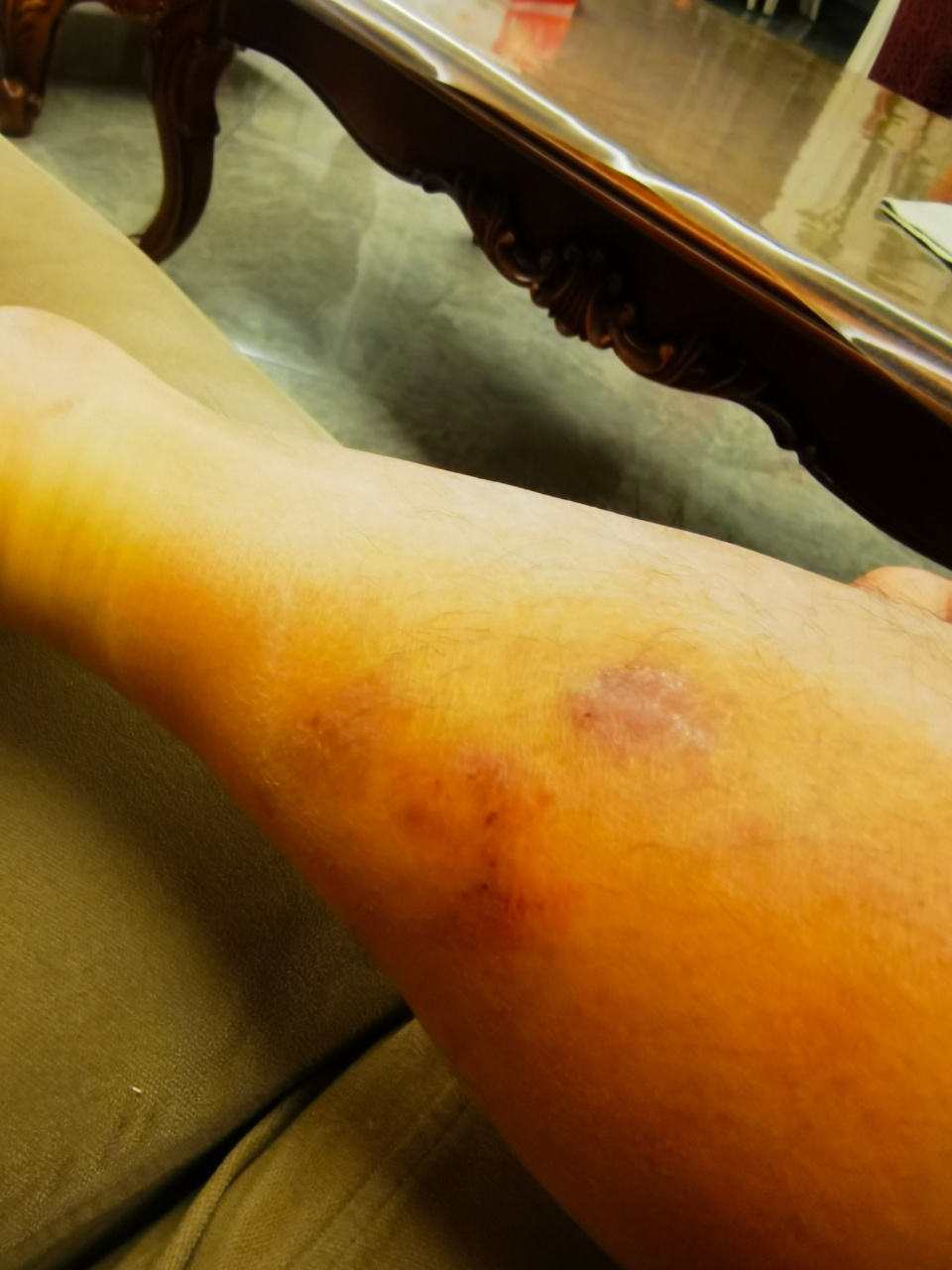 特应性皮炎症状.#特应性皮炎