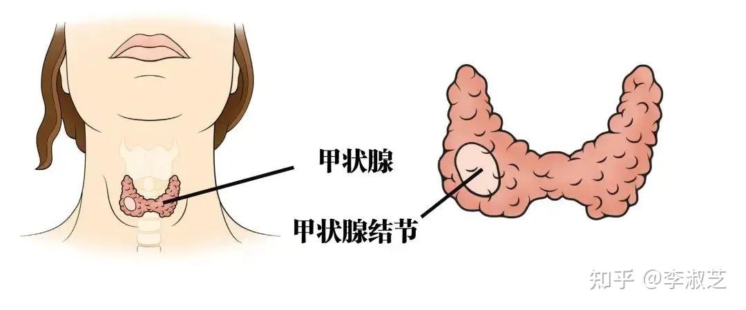 健康科普甲状腺功能异常也会影响到白癜风病情吗