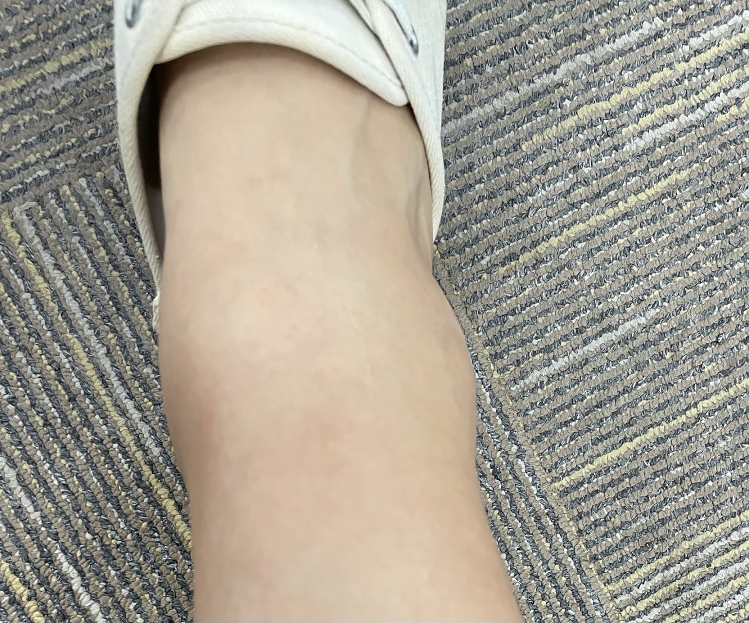 跳绳后脚踝肿了,走路很疼 只跳了一周多,每天1000来个,就变成这样了