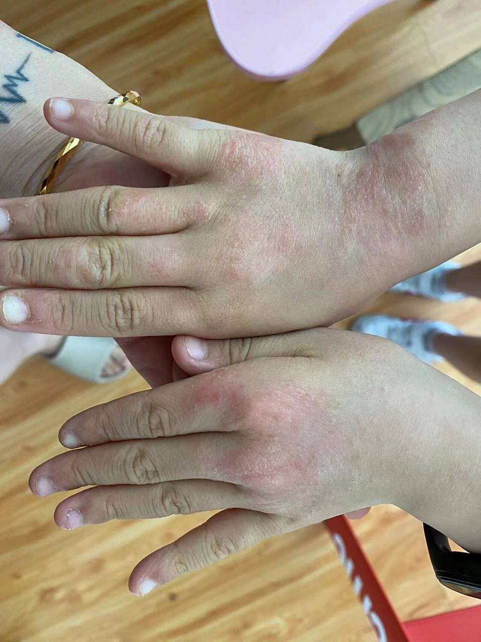 怎么判断特异性皮疹 94湿疹中的王炸~特异性湿疹也叫特异性皮炎