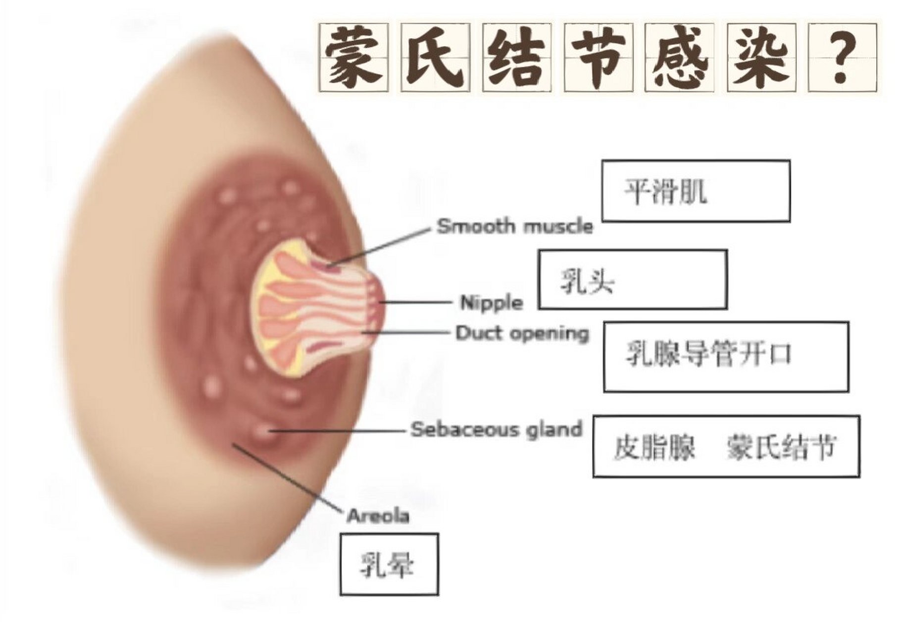 正常乳房蒙氏结节怀孕图片