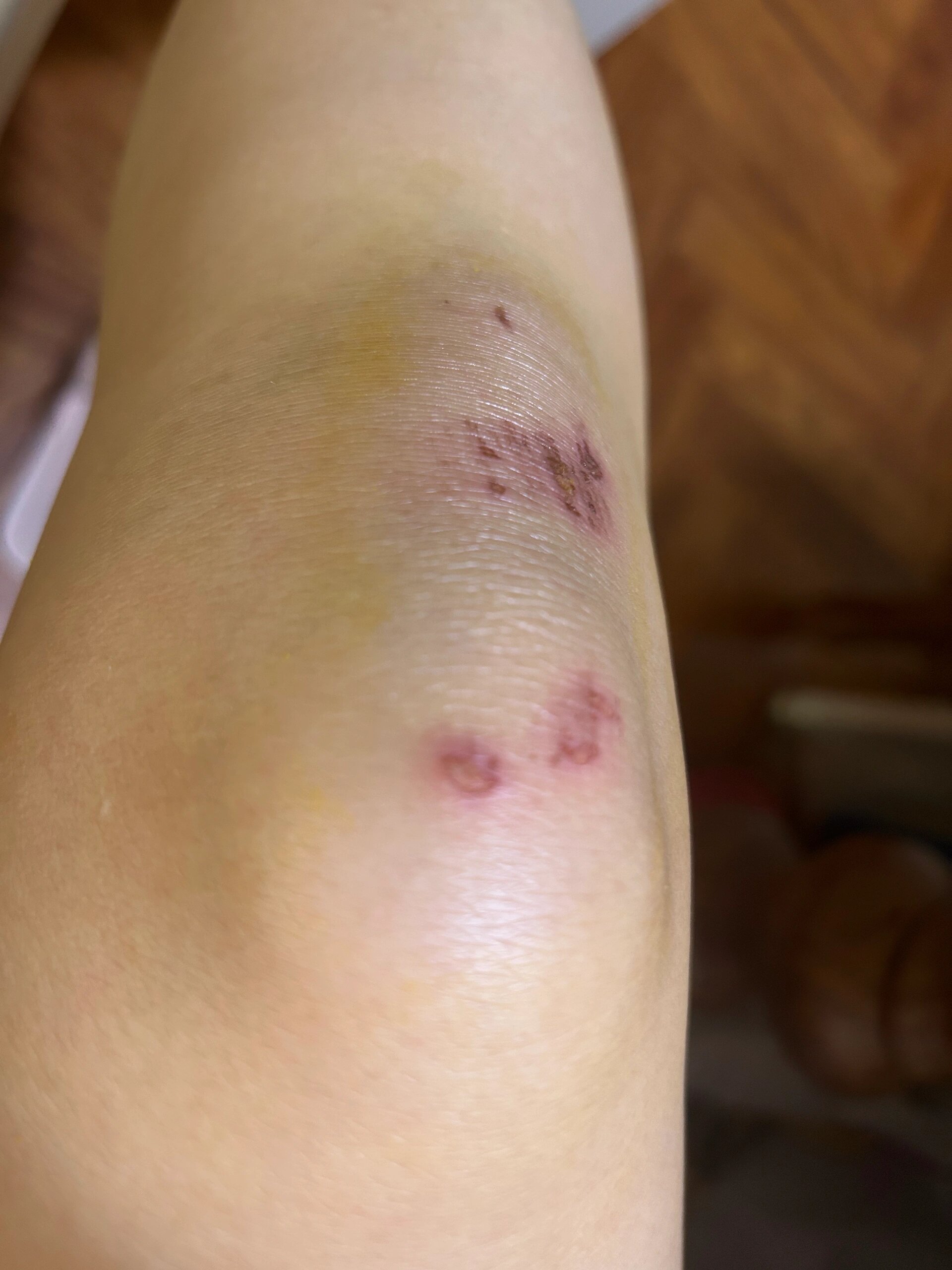 摔倒后一个月了,膝盖还是疼可如何是好