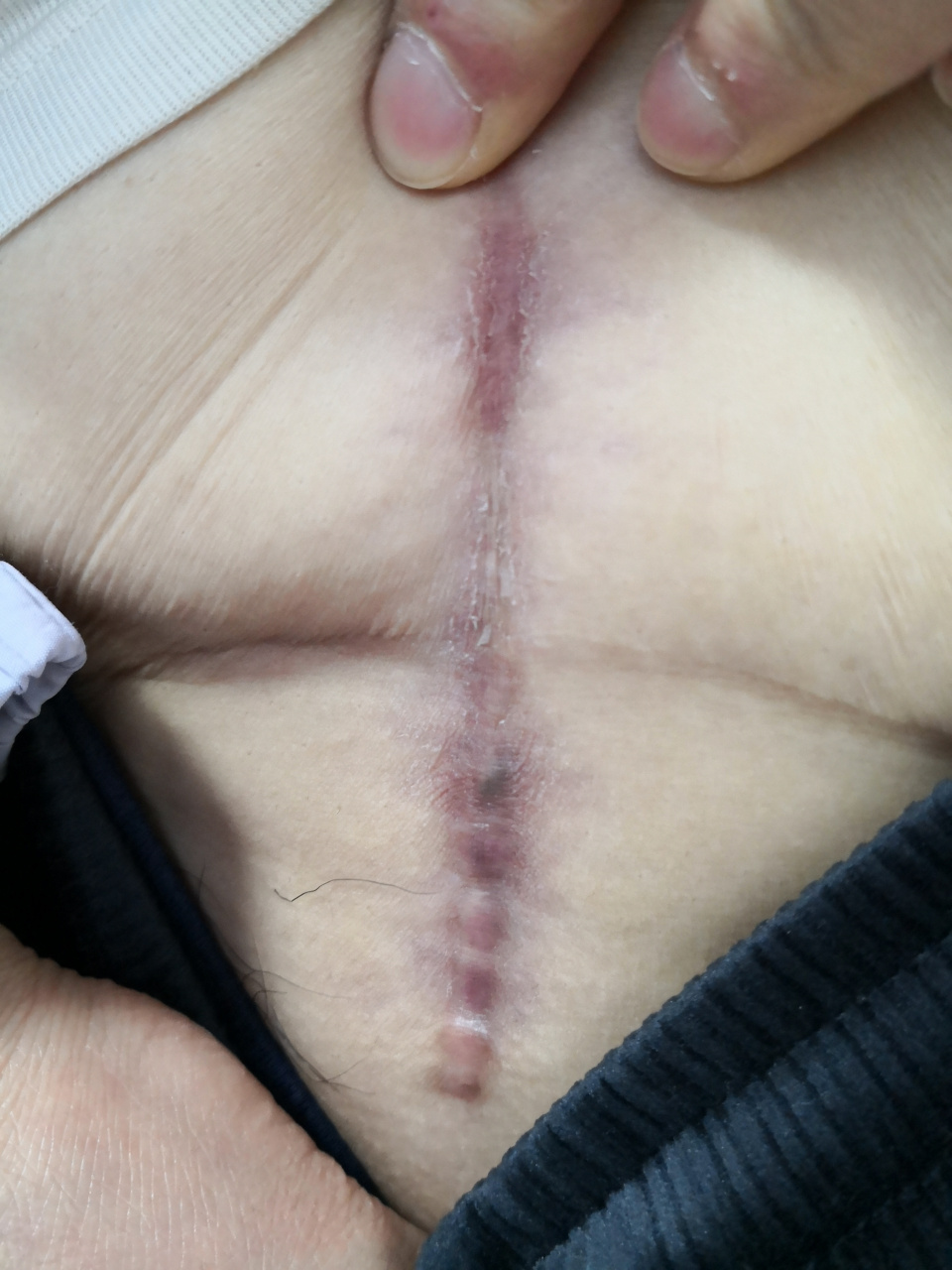 剖宫产手术刀口瘢痕疙瘩症状