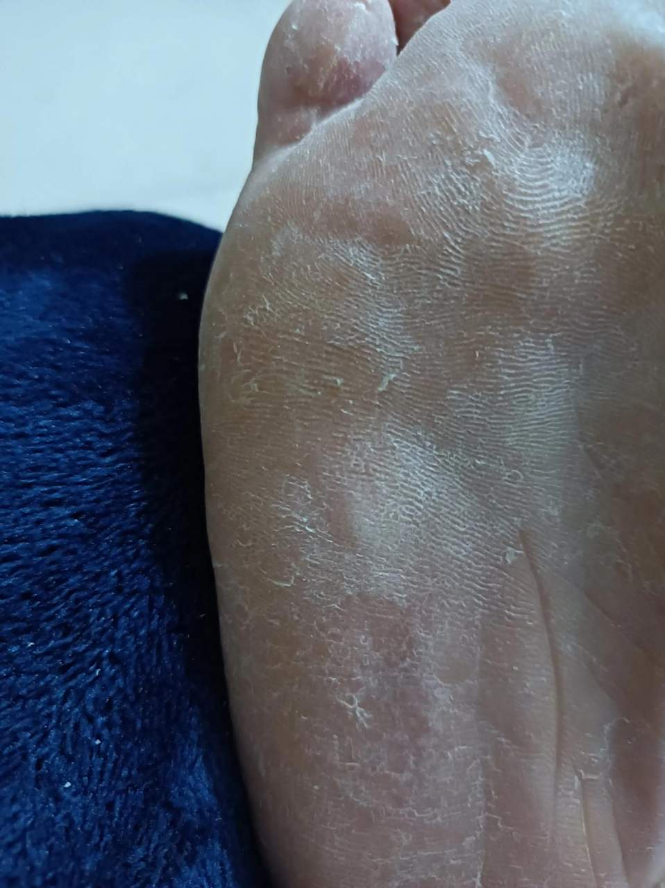 脚底下长鸡眼睛!我相信大家都痛恨!我通过自身经历算是彻底治好了!