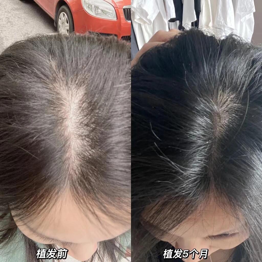 发缝变宽植发加密(发缝加密需要剃头发吗)