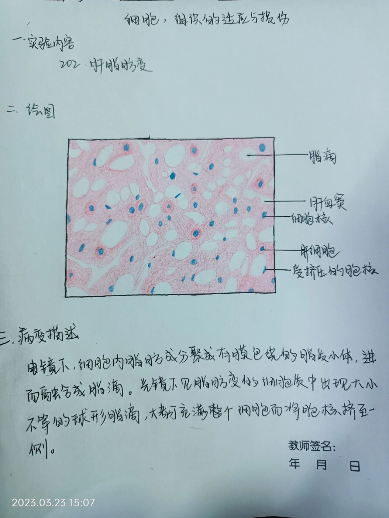 病理肝细胞脂肪变