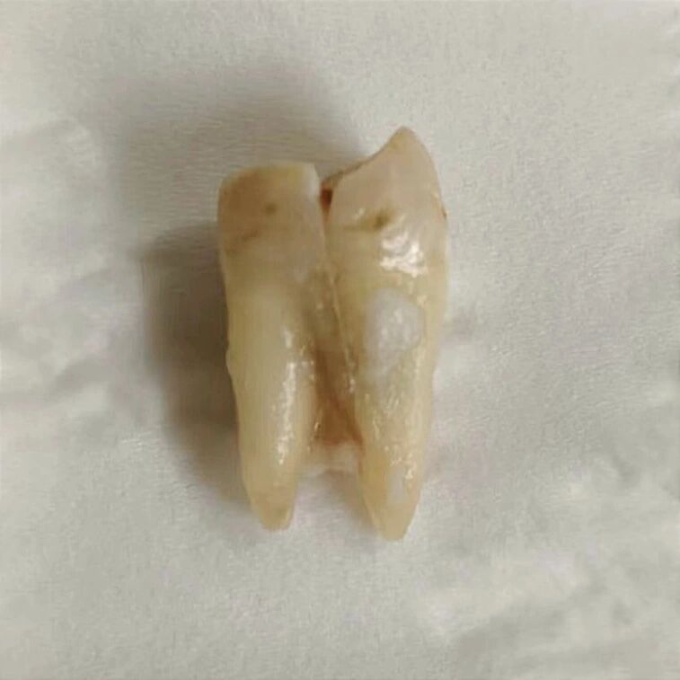 尤其是那些牙齿表面有隐裂纹的,牙齿抽了神经做了根管的!