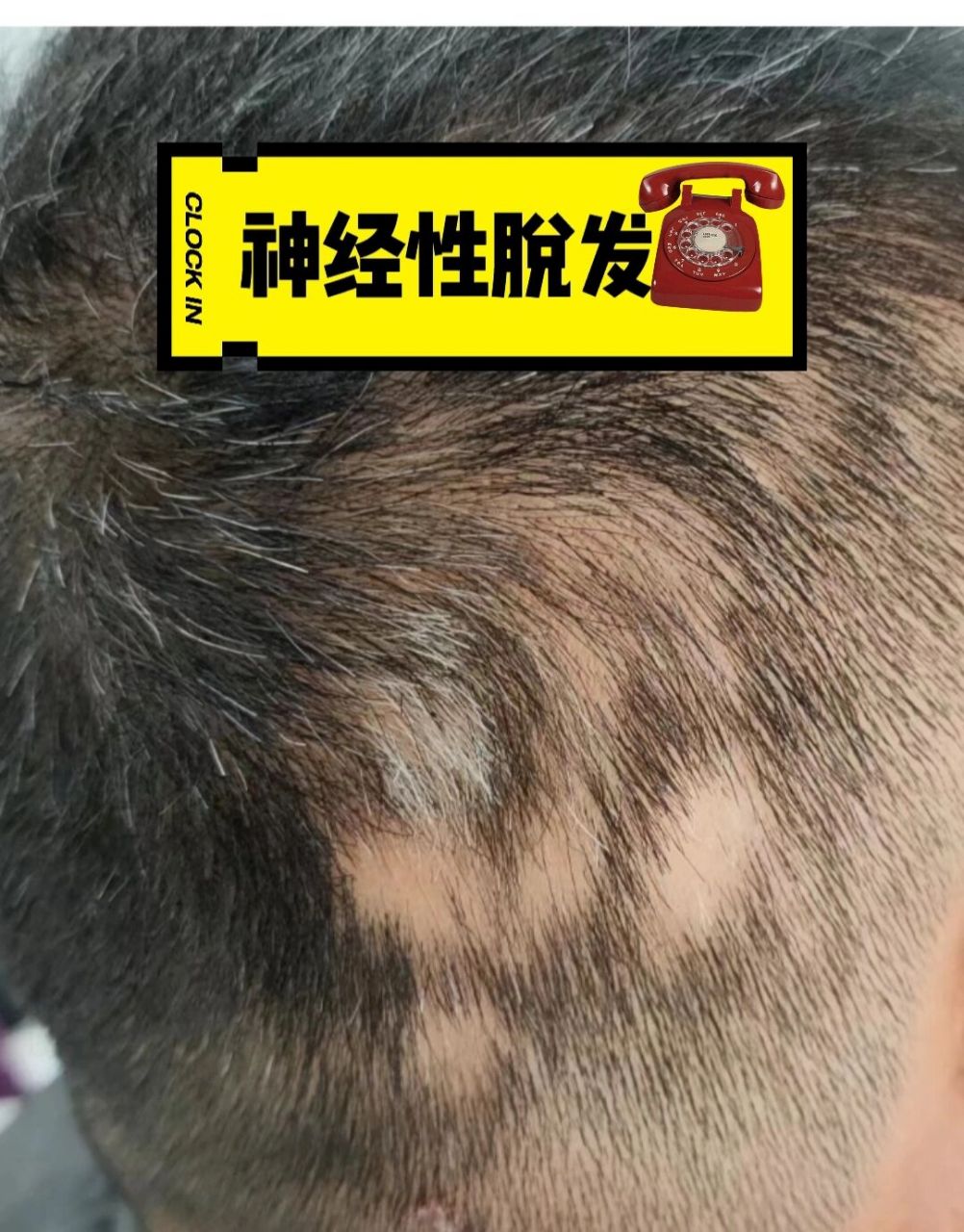 神经性脱发 9292今天早上起来就开始忙,6:30有顾客约调理脱发,7