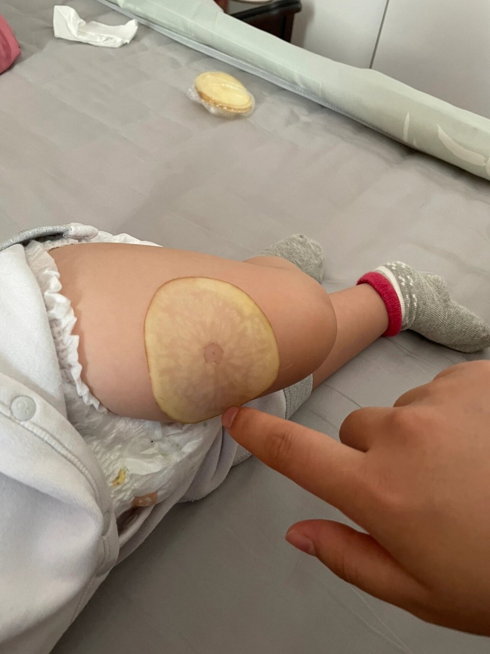 十三价肺炎接种完针眼红肿 今早去打的第三针疫苗,我们打得国产的,第