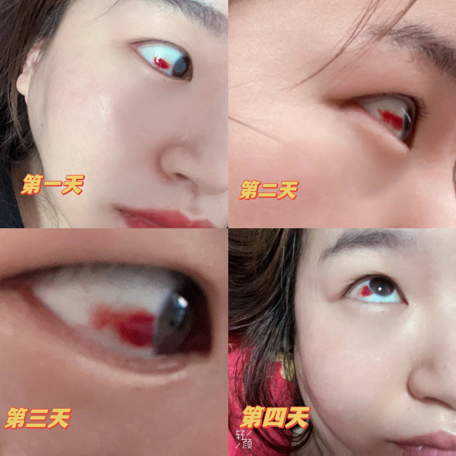 莫名其妙眼睛出现了红色血块