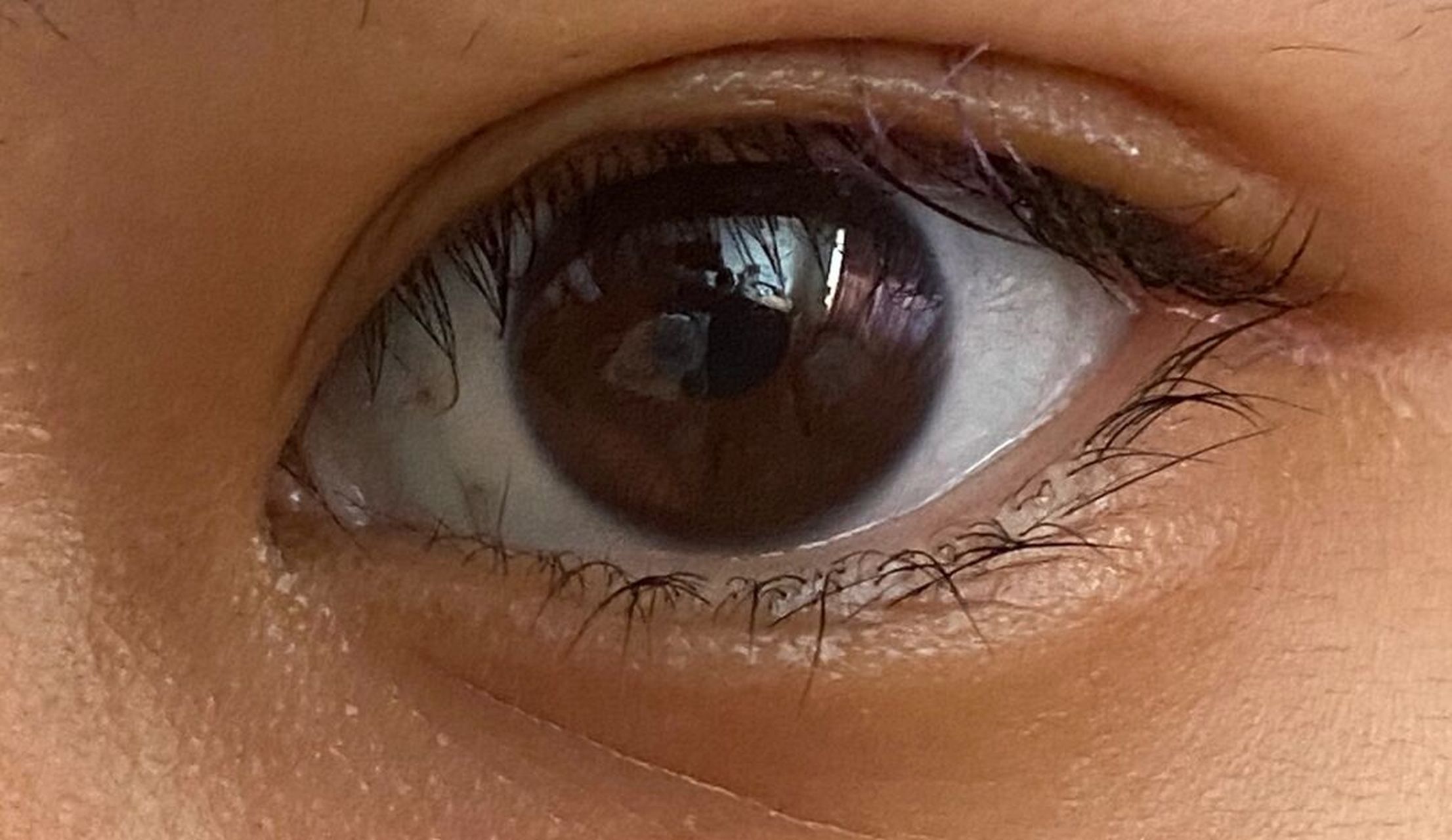 上眼睑痣 这颗痣长在右边上眼睑中间,因为害怕做掉之后眼眶会有缺损