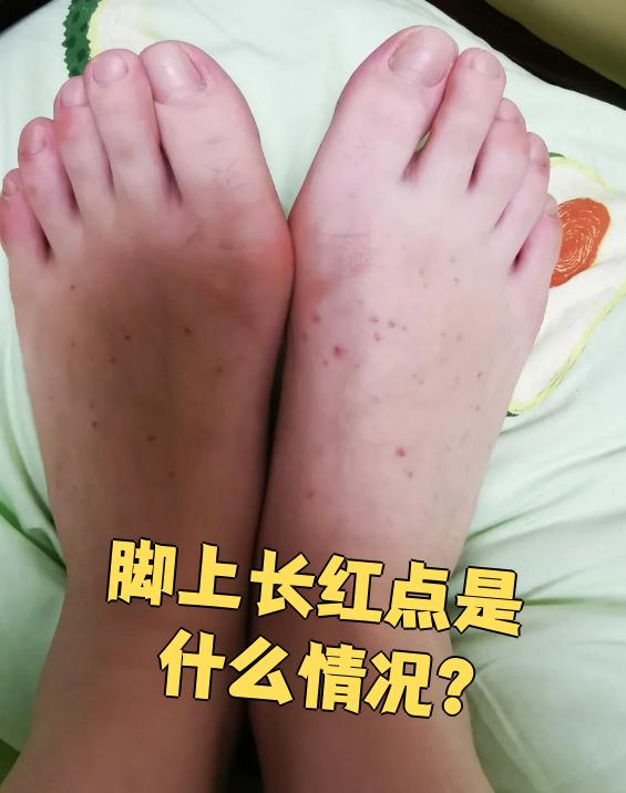为什么脚上会有很多红点