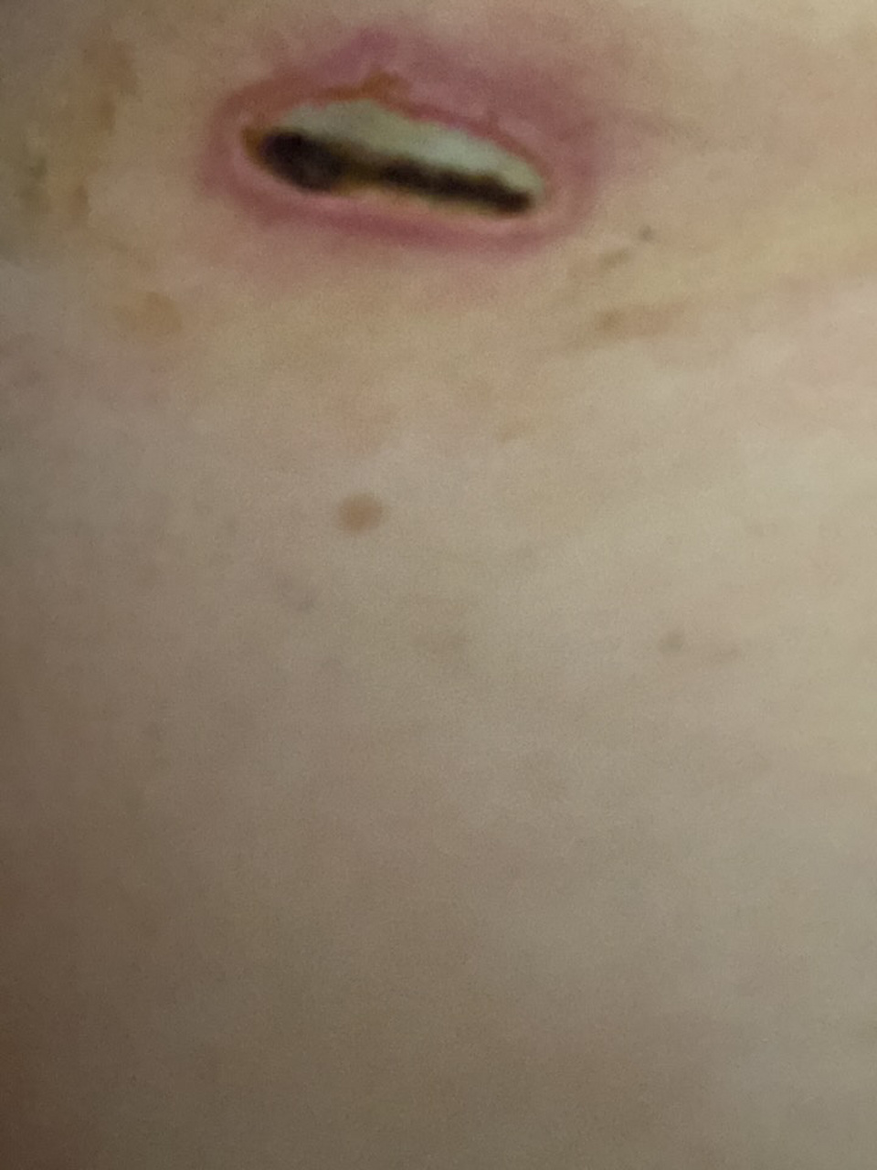 帮我看看我是不是肋骨伤口感染了 拆线的第二天不小心滴到了两滴水