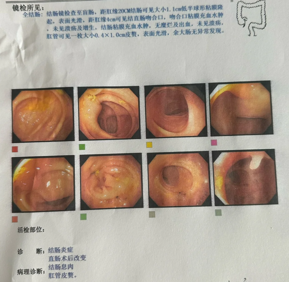 肛门息肉通常指的是肛乳头瘤,这种息肉一般不会自己消失,大多数歇要