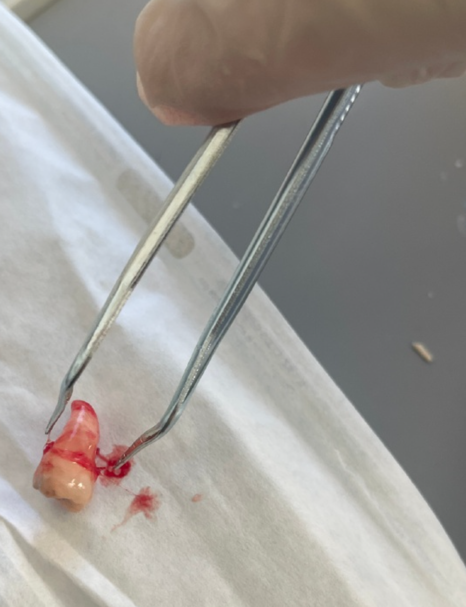 两颗牙齿长重叠了,这可能是乳牙滞留,多生牙或者牙齿畸形造成的