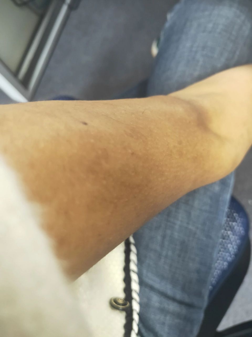 手臂大面积黑色素,皮肤粗糙,时间长,怎么改善求解