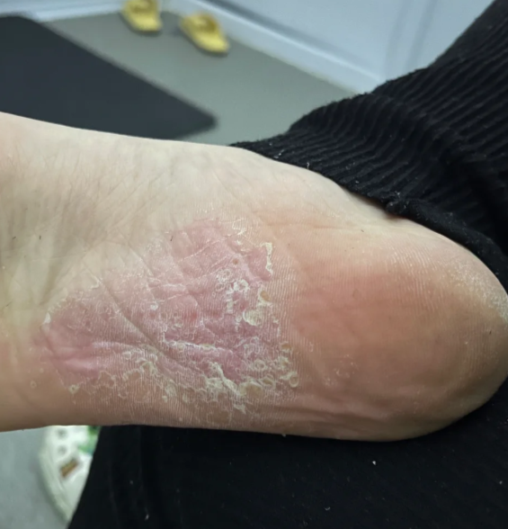 脚气真菌怎么治能除根?