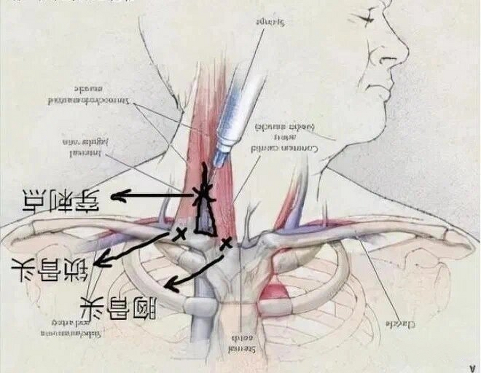 股静脉穿刺置管术图解图片