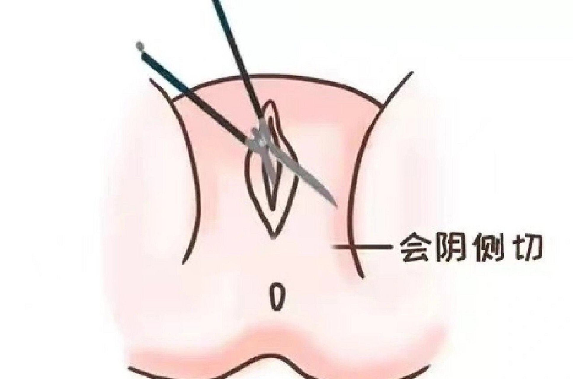 顺产侧切位置图片