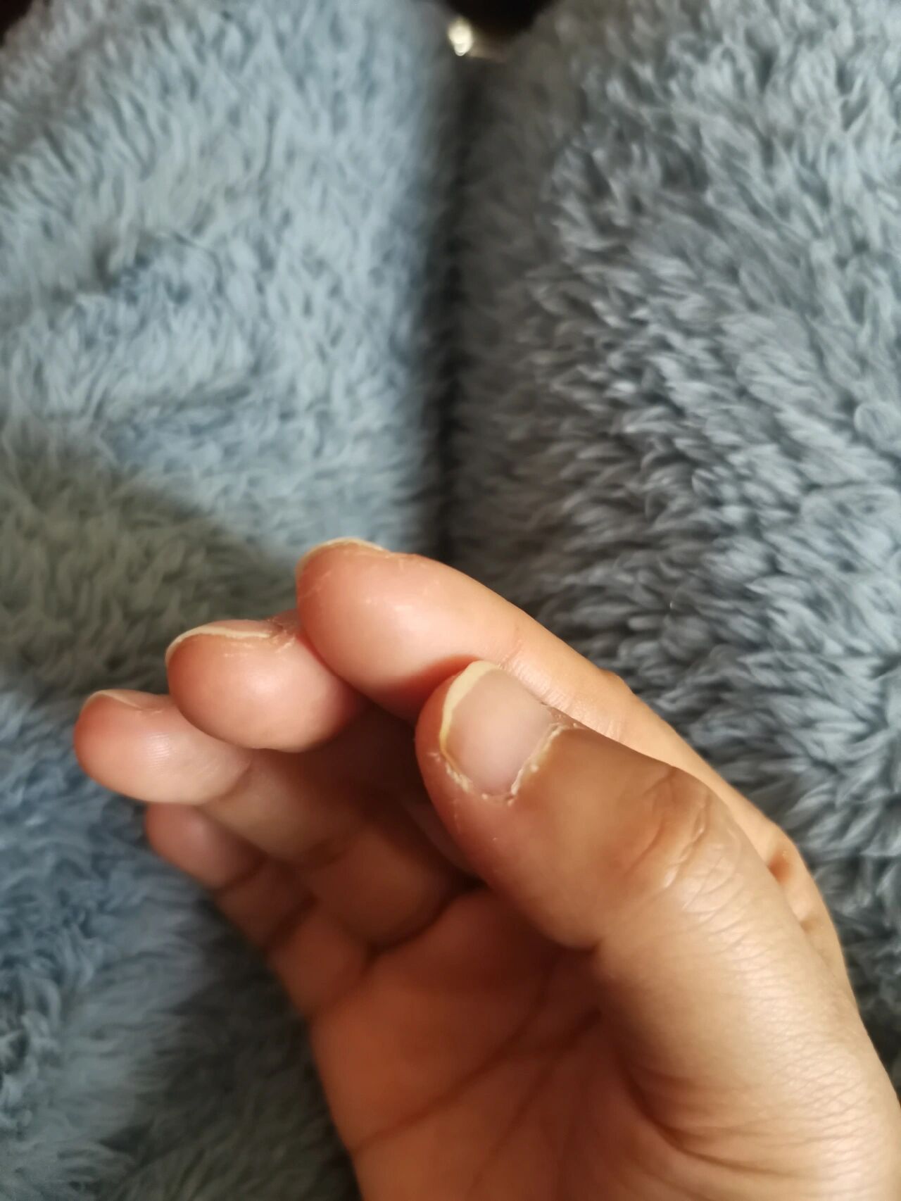 口服卡培他滨的手足综合症怎么破